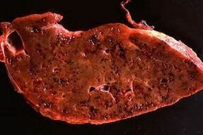 parasites in human liver